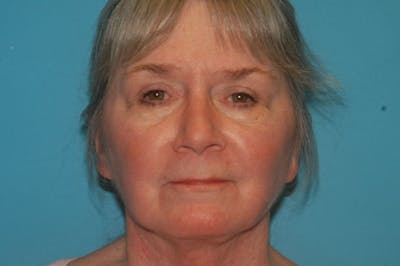 Facelift Before & After Gallery - Patient 8795313 - Image 2
