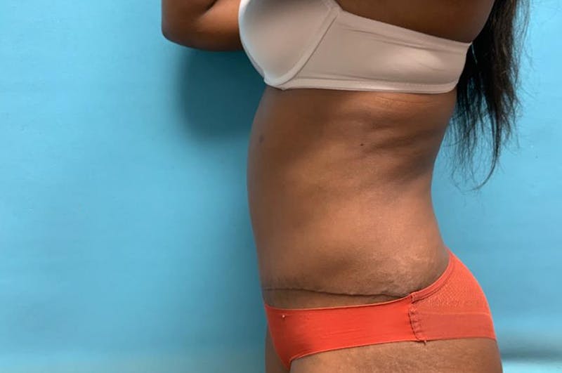 Abdominoplasty Before & After Gallery - Patient 8795314 - Image 6