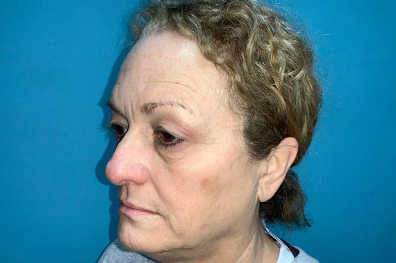 Eyelid Surgery Before & After Gallery - Patient 8795316 - Image 5