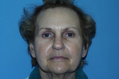 Facelift Before & After Gallery - Patient 8795315 - Image 1