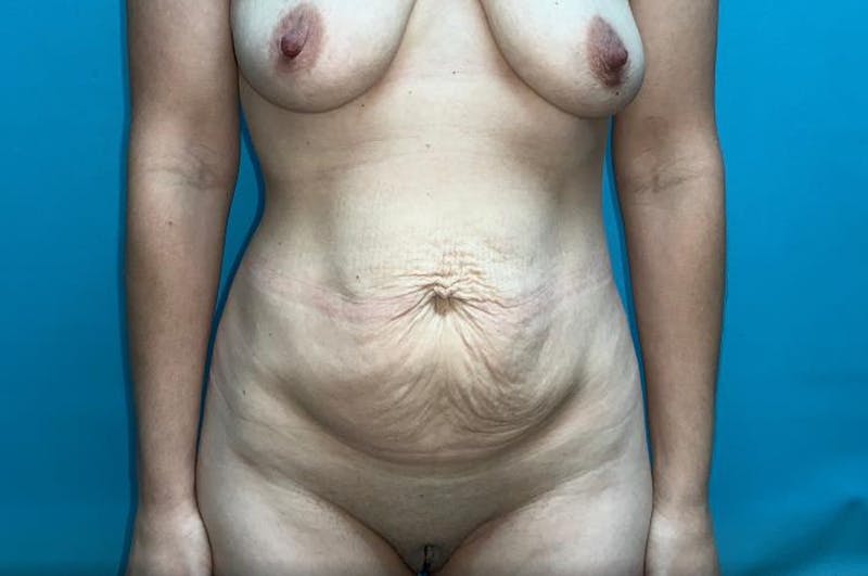 Abdominoplasty Before & After Gallery - Patient 8795340 - Image 1