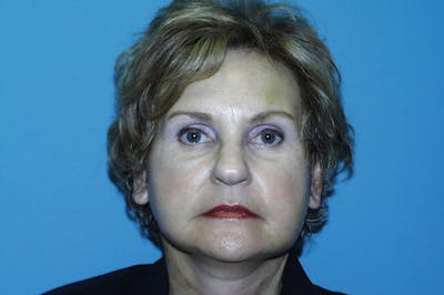 Facelift Before & After Gallery - Patient 8795315 - Image 2