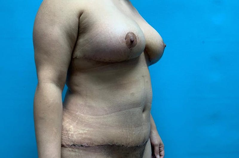 Mastopexy Before & After Gallery - Patient 8795337 - Image 4