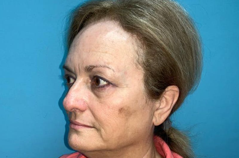 Eyelid Surgery Before & After Gallery - Patient 8795316 - Image 6