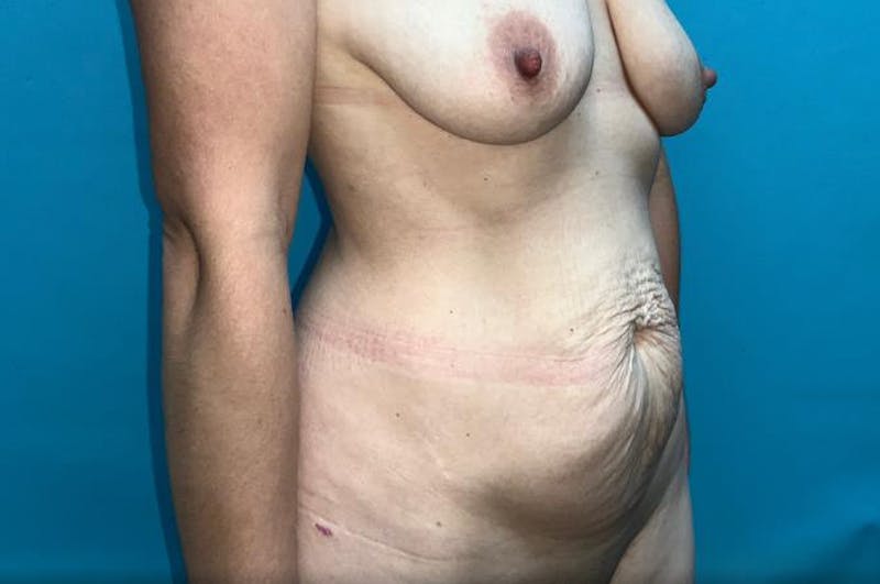 Abdominoplasty Before & After Gallery - Patient 8795340 - Image 3