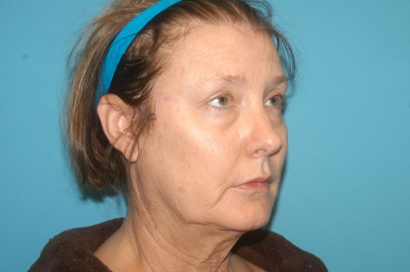 Facelift Before & After Gallery - Patient 8795339 - Image 3