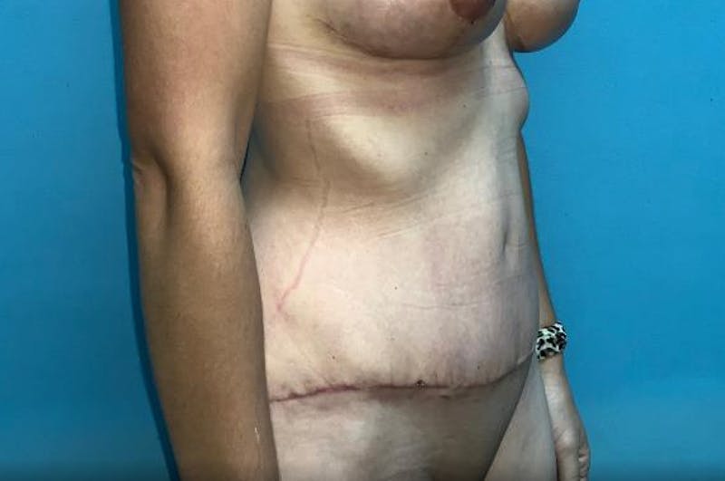 Abdominoplasty Before & After Gallery - Patient 8795340 - Image 4