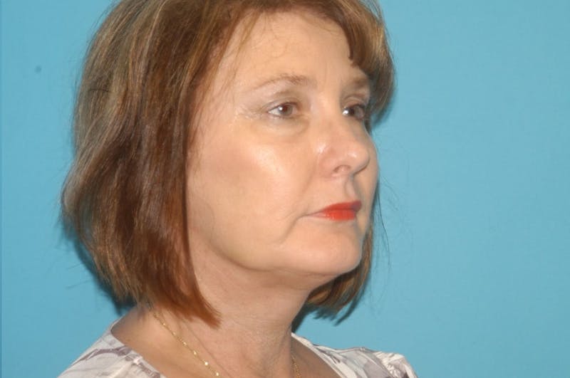 Facelift Before & After Gallery - Patient 8795339 - Image 4