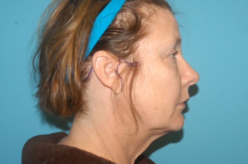 Facelift Before & After Gallery - Patient 8795339 - Image 5