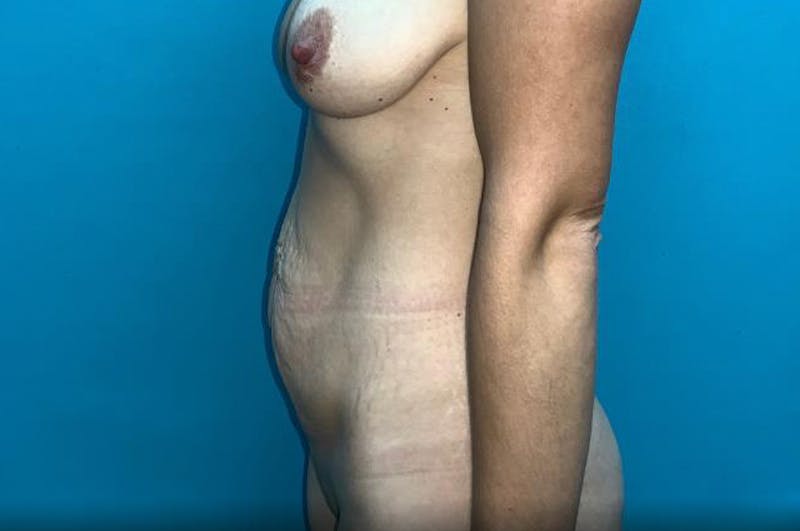 Abdominoplasty Before & After Gallery - Patient 8795340 - Image 5