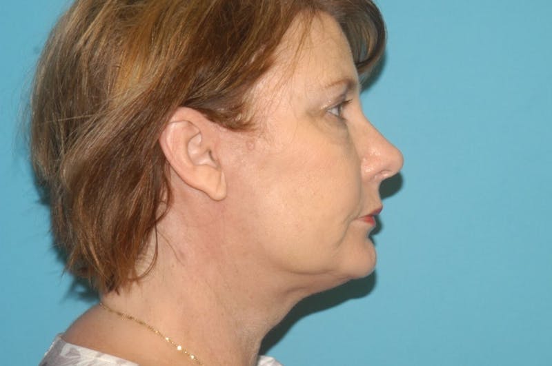 Facelift Before & After Gallery - Patient 8795339 - Image 6