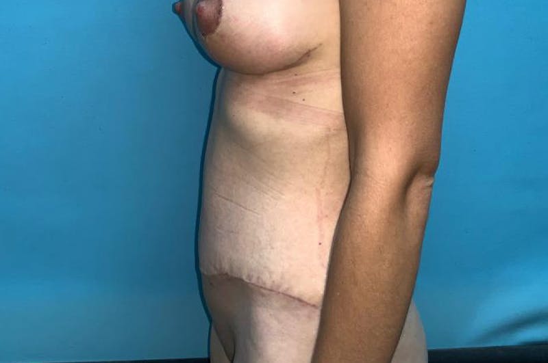 Abdominoplasty Before & After Gallery - Patient 8795340 - Image 6