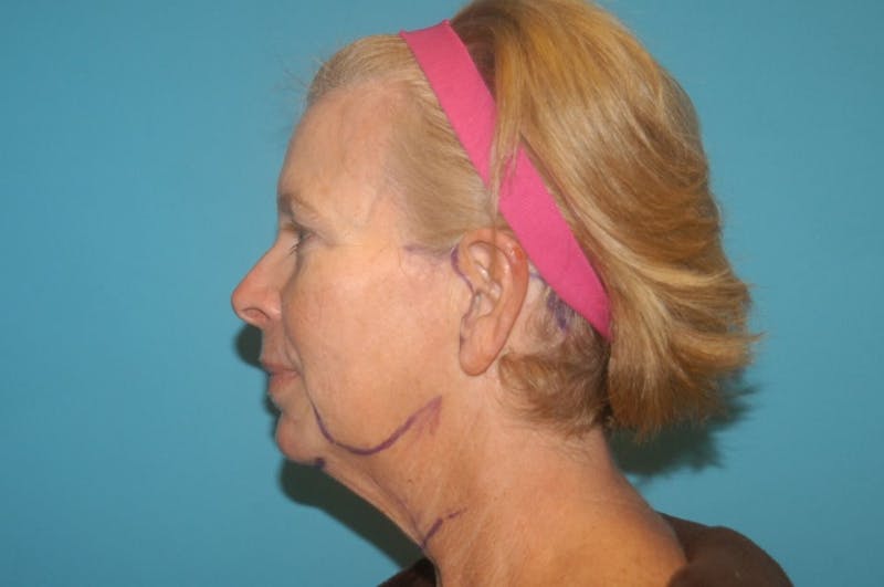 Facelift Before & After Gallery - Patient 8795343 - Image 1