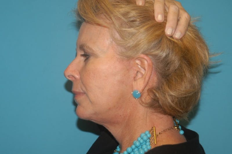 Facelift Before & After Gallery - Patient 8795343 - Image 2