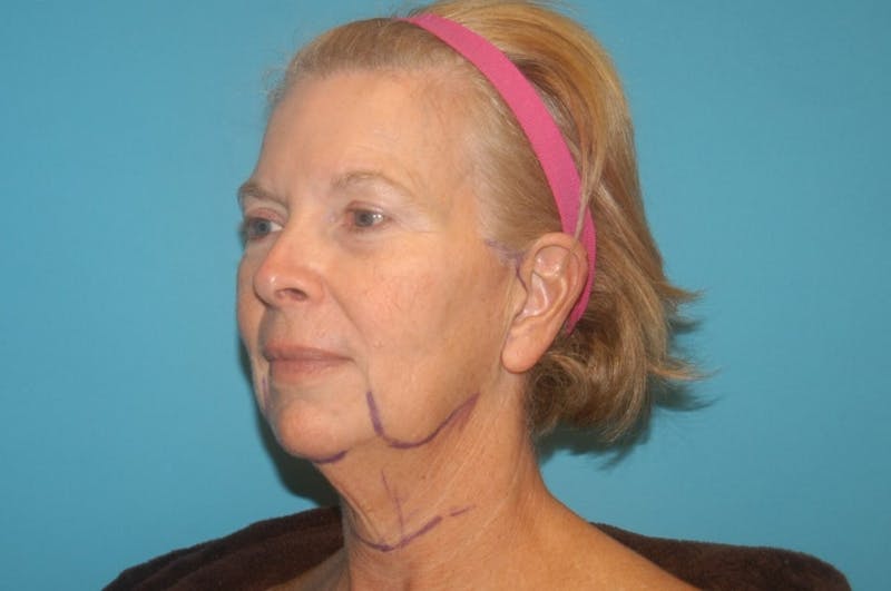 Facelift Before & After Gallery - Patient 8795343 - Image 3