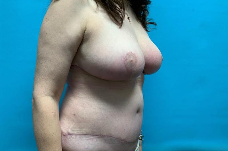 Mastopexy Before & After Gallery - Patient 8795342 - Image 4