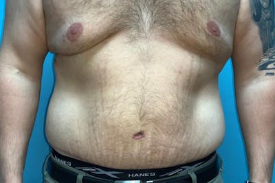 Abdominoplasty Before & After Gallery - Patient 8795361 - Image 2