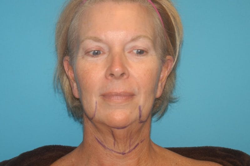 Facelift Before & After Gallery - Patient 8795343 - Image 5