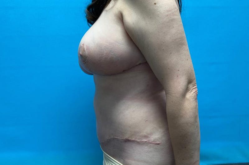 Mastopexy Before & After Gallery - Patient 8795342 - Image 6