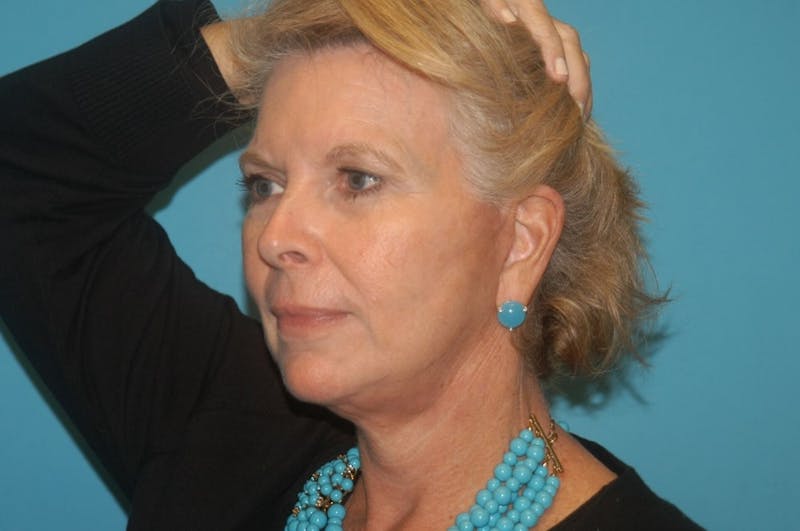 Facelift Before & After Gallery - Patient 8795343 - Image 7