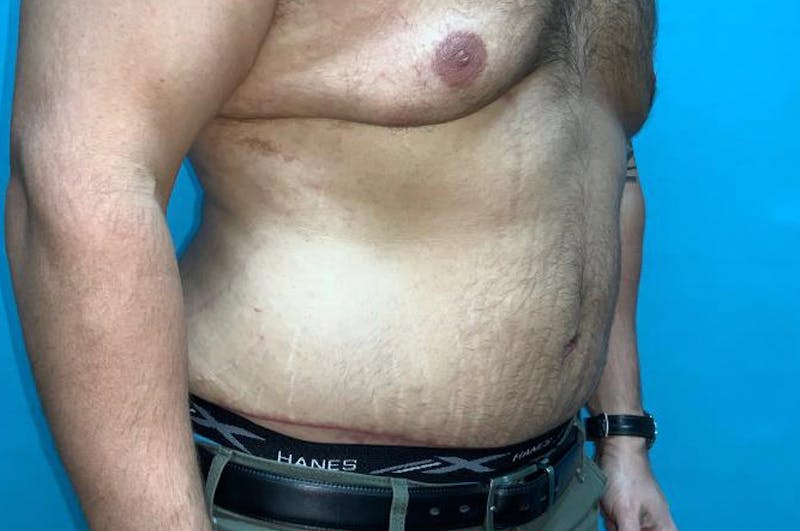 Abdominoplasty Before & After Gallery - Patient 8795361 - Image 4