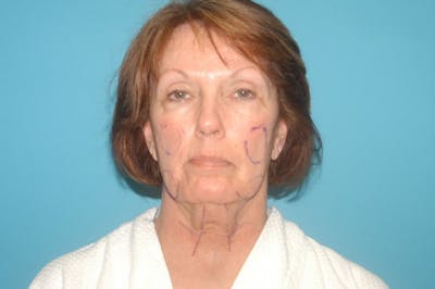 Facelift Before & After Gallery - Patient 8795362 - Image 1