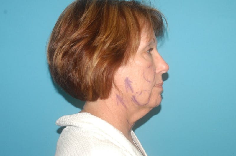 Facelift Before & After Gallery - Patient 8795362 - Image 3