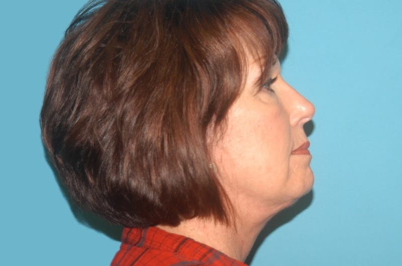 Facelift Before & After Gallery - Patient 8795362 - Image 4