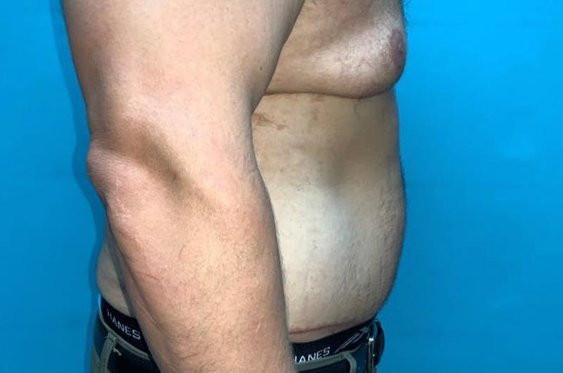 Abdominoplasty Before & After Gallery - Patient 8795361 - Image 6