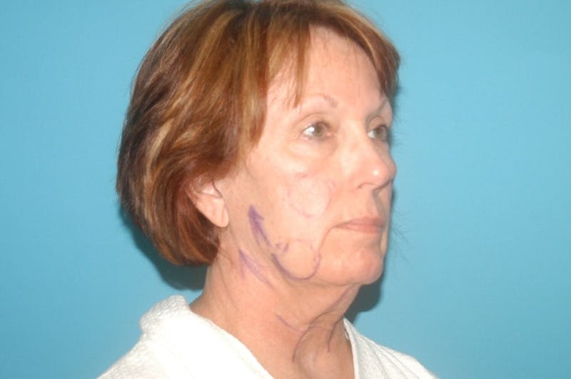 Facelift Before & After Gallery - Patient 8795362 - Image 5