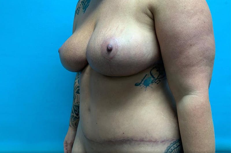 Mastopexy Before & After Gallery - Patient 8795365 - Image 4