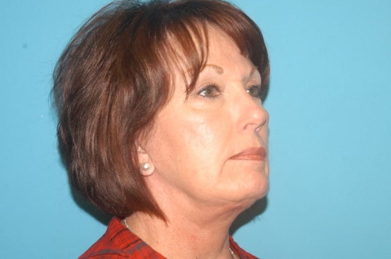 Facelift Before & After Gallery - Patient 8795362 - Image 6