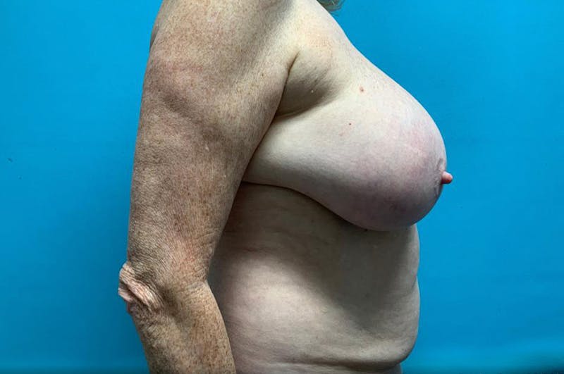 Abdominoplasty Before & After Gallery - Patient 8795371 - Image 5