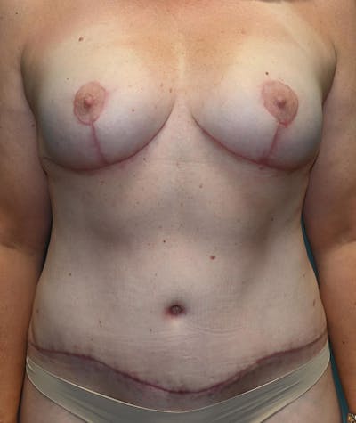Mommy Makeover Before & After Gallery - Patient 8795378 - Image 2