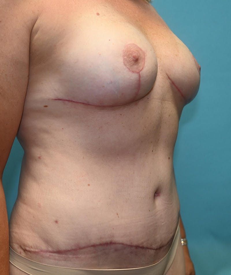 Mommy Makeover Before & After Gallery - Patient 8795378 - Image 4