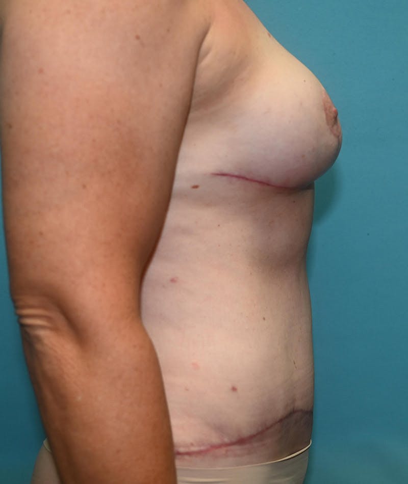 Mommy Makeover Before & After Gallery - Patient 8795378 - Image 6