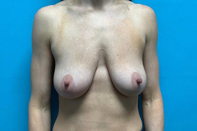Mastopexy Before & After Gallery - Patient 8795381 - Image 1