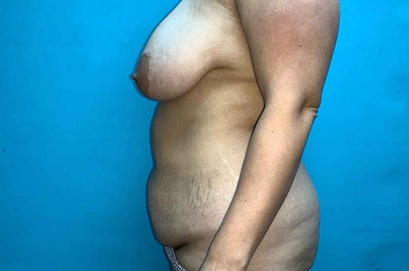 Abdominoplasty Before & After Gallery - Patient 8795379 - Image 5