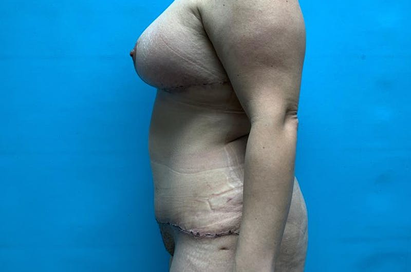 Abdominoplasty Before & After Gallery - Patient 8795379 - Image 6