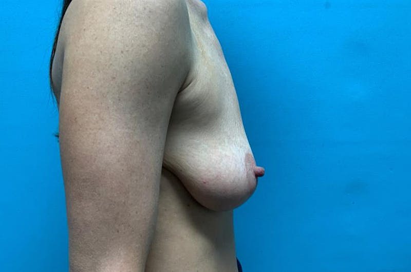 Mastopexy Before & After Gallery - Patient 8795381 - Image 5
