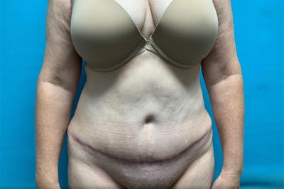 Liposuction Before & After Gallery - Patient 8795400 - Image 2