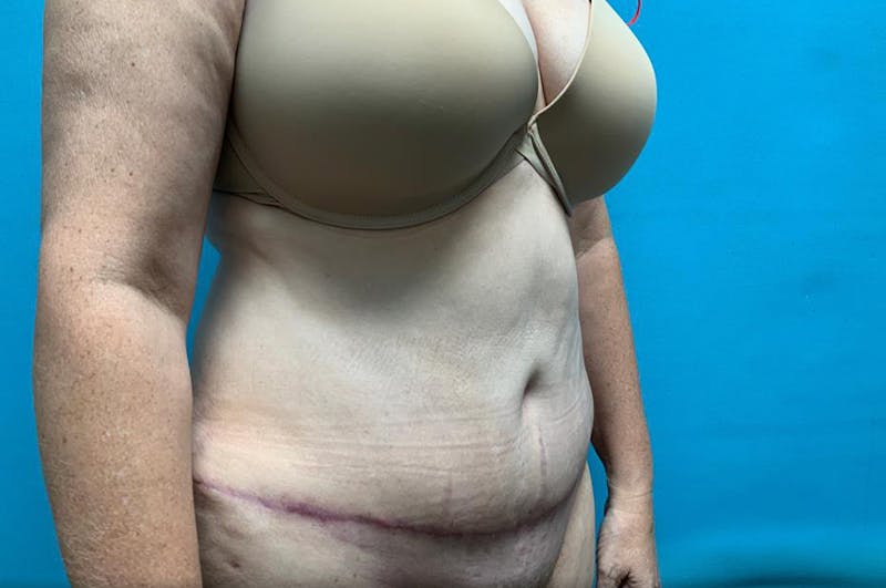 Liposuction Before & After Gallery - Patient 8795400 - Image 4