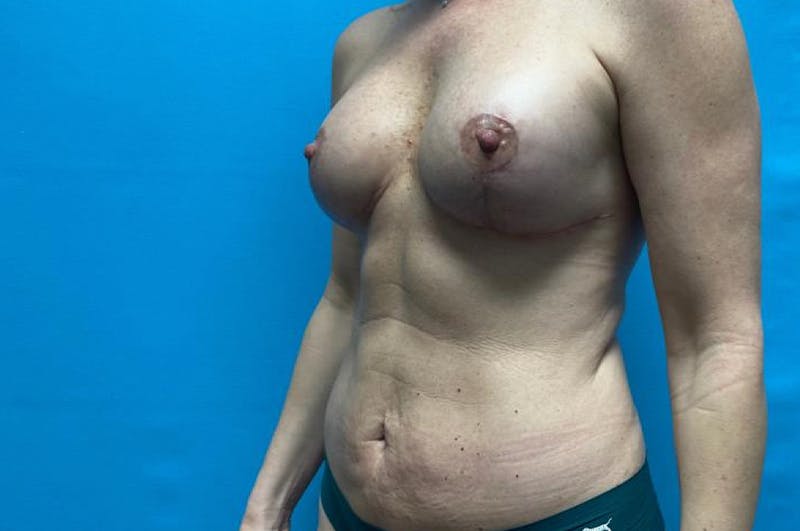 Mastopexy Before & After Gallery - Patient 8795401 - Image 4