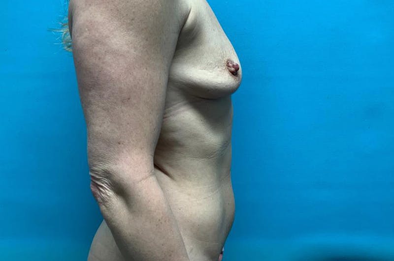 Mastopexy Before & After Gallery - Patient 8795401 - Image 5