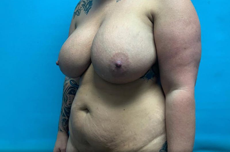 Abdominoplasty Before & After Gallery - Patient 8795403 - Image 3