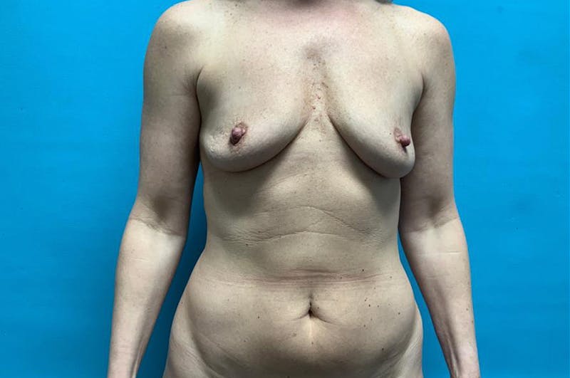 Liposuction Before & After Gallery - Patient 8795426 - Image 1