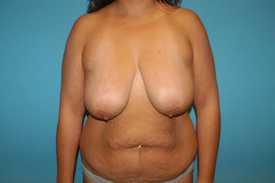 Mastopexy Before & After Gallery - Patient 8795404 - Image 1