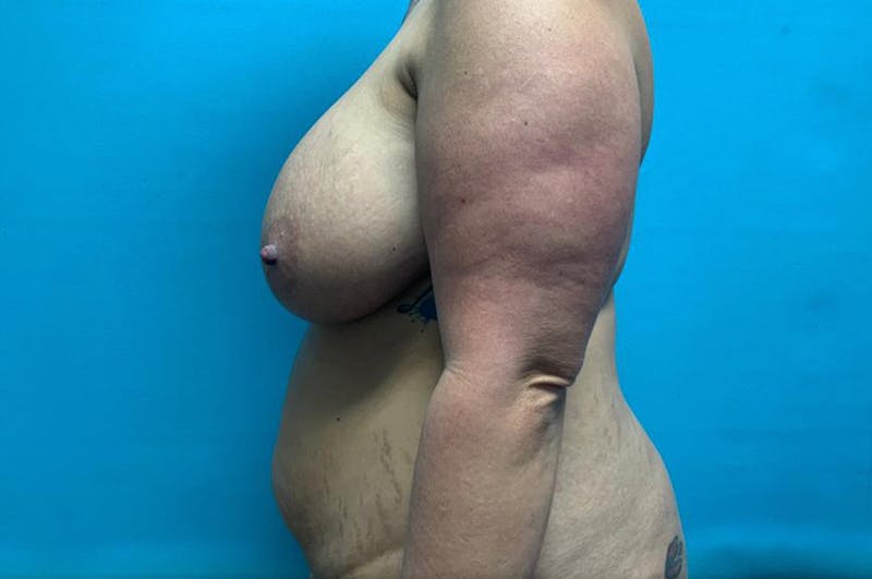 Abdominoplasty Before & After Gallery - Patient 8795403 - Image 5