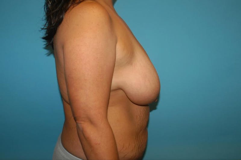 Mastopexy Before & After Gallery - Patient 8795404 - Image 3