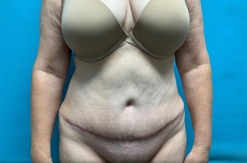 Abdominoplasty Before & After Gallery - Patient 8795427 - Image 2
